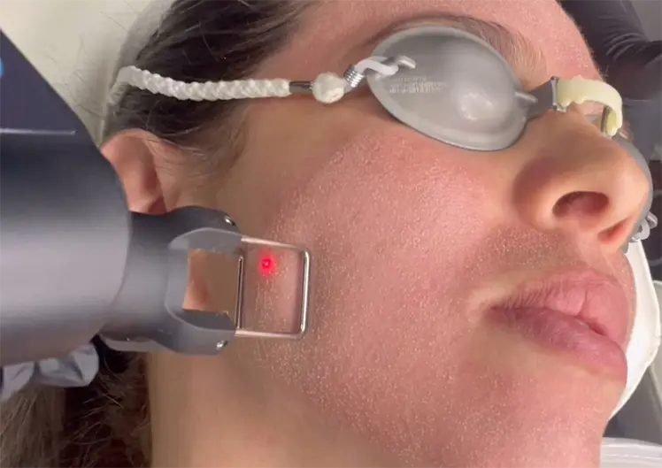 Laser Treatments